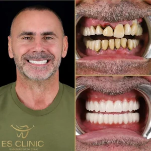 ES CLINIC KONYAALTI ANTALYA INSTAGRAM 01